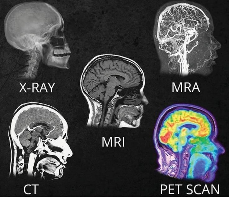 Differences between X-Ray, MRA, MRI, PET, CT