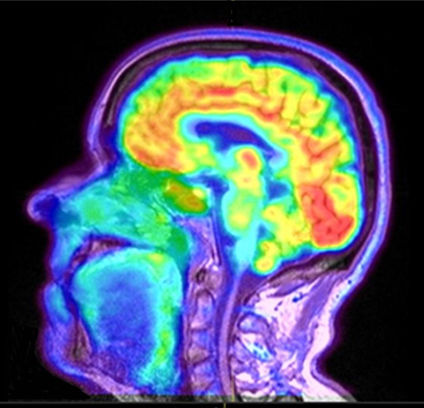 PET Brain Scan